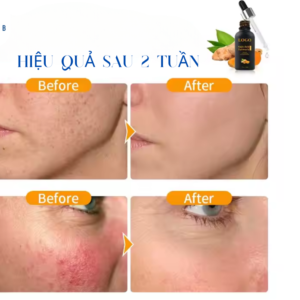 Dạy làm serum nám