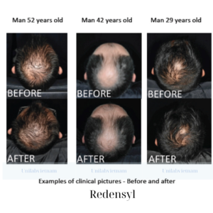 Redensyl - Hoạt Chất Kích Thích Mọc Tóc